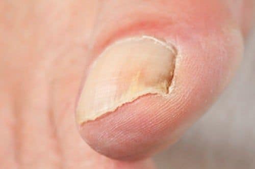 Leczenie wrastającego paznokcia – Zakliczyn i okolice 2 Leczenie wrastającego paznokcia – Zakliczyn i okolice