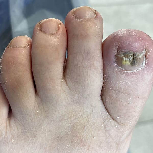 Grzybica paznokci u stóp - Podolog Zakliczyn 2 Grzybica paznokci u stóp – Podolog Zakliczyn