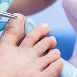 Czy wrastający paznokieć zawsze boli- Podolog Zakliczyn