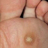 Usuwanie odcisków i modzeli – Zakliczyn i okolice 2 Usówanie odcisków - Podolog Wojnicz