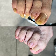 Pedicure podologiczny – Zakliczyn i okolice 2 Pedicure podologiczny - Podolog Zakliczyn