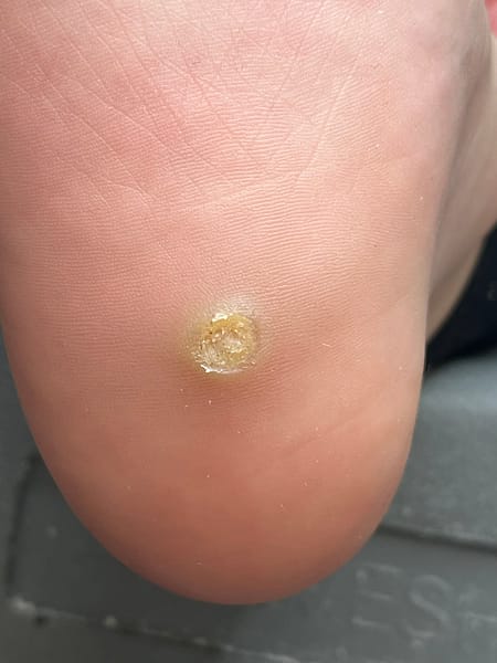 Usuwanie brodawek podeszwowych – Zakliczyn i okolice 1 Usuwanie brodawek - Podolog Zakliczyn