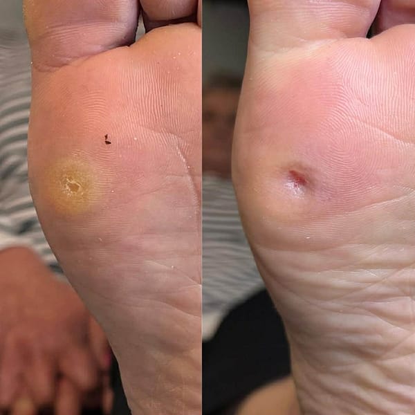 Usuwanie odcisków i modzeli – Zakliczyn i okolice 1 Usuwanie odcisków -Podolog Zakliczyn