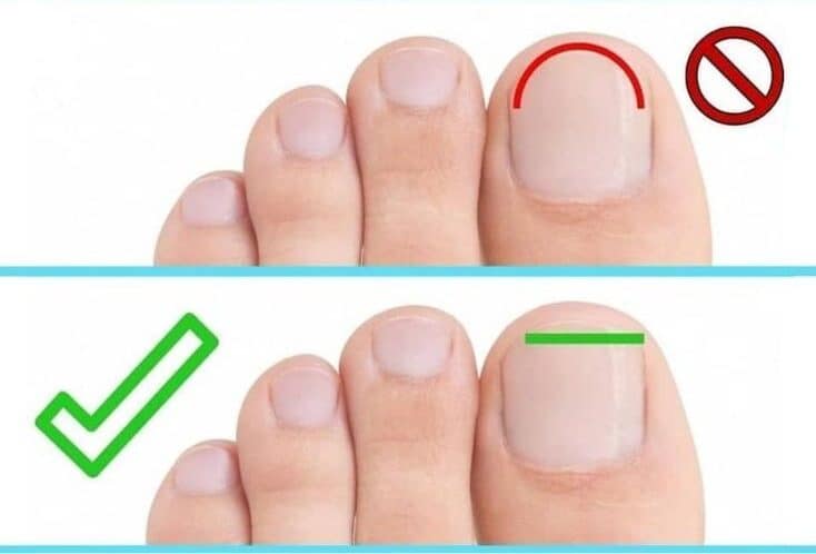 Jak obcinać paznokcie u stóp 1 Jak obcinać paznokcie u stóp