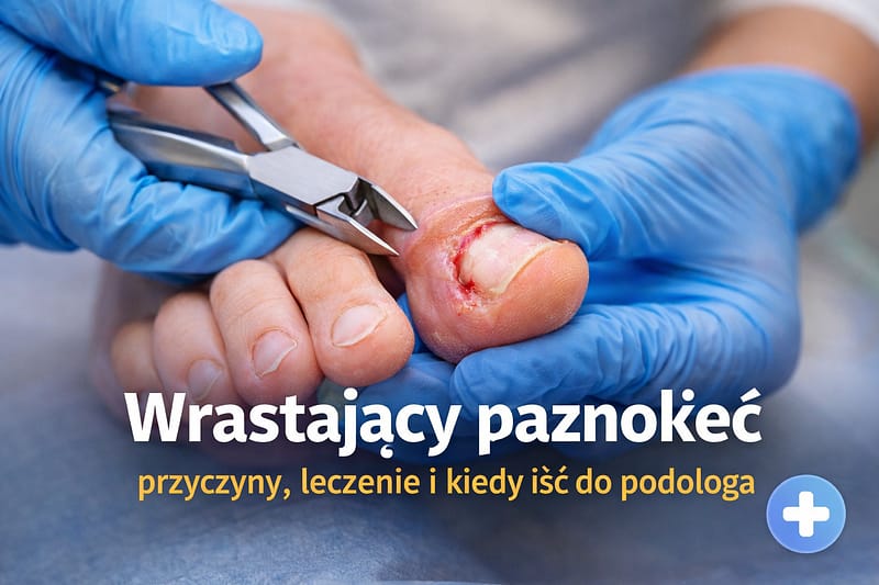 Wrastający paznokieć – przyczyny, objawy i leczenie 1 wrastający paznokieć leczenie podolog
