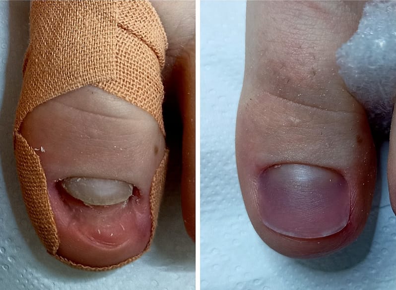 Rekonstrukcja paznokcia – Zakliczyn i okolice 1 Rekonstrukcja paznokcia - Podolog Zakliczyn